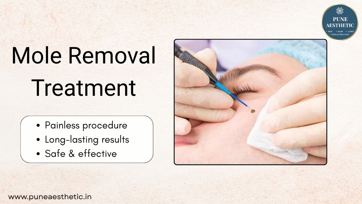 Mole Removal Treatment in Pune – Safe & Professional Mole Removal at Pune Aesthetic
