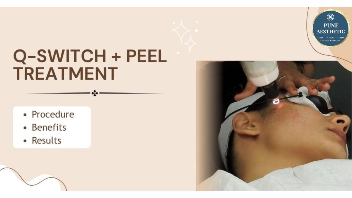 “Q-Switch Laser + Peel Treatment in Pune: Dual-Action Brightening for Clearer, Spot-Free, Glowing Skin”