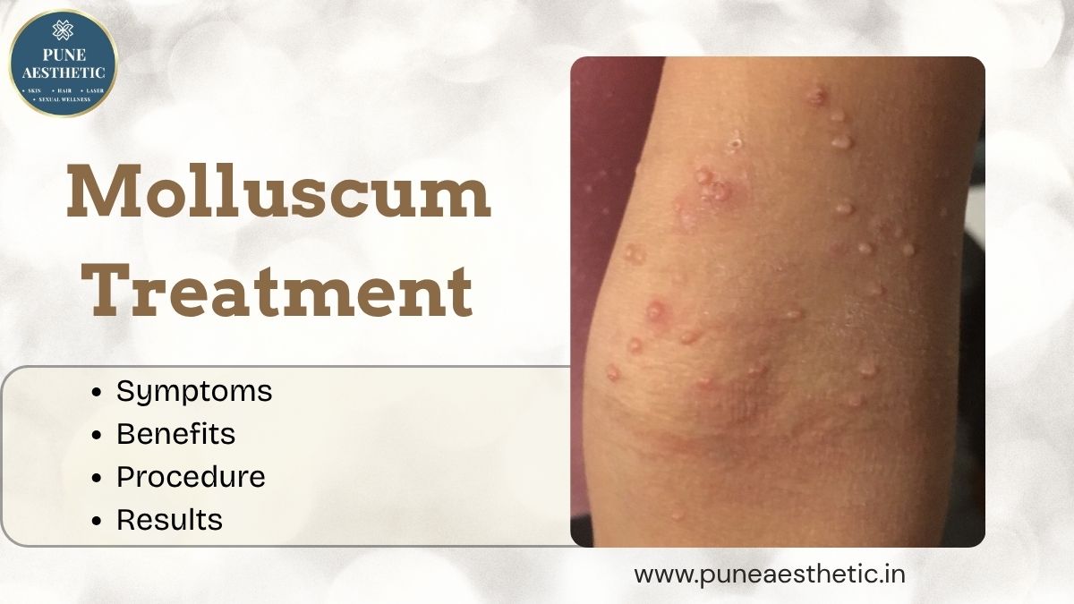 Molluscum Treatment in Pune: Causes, Procedure, Benefits, Results & Aftercare