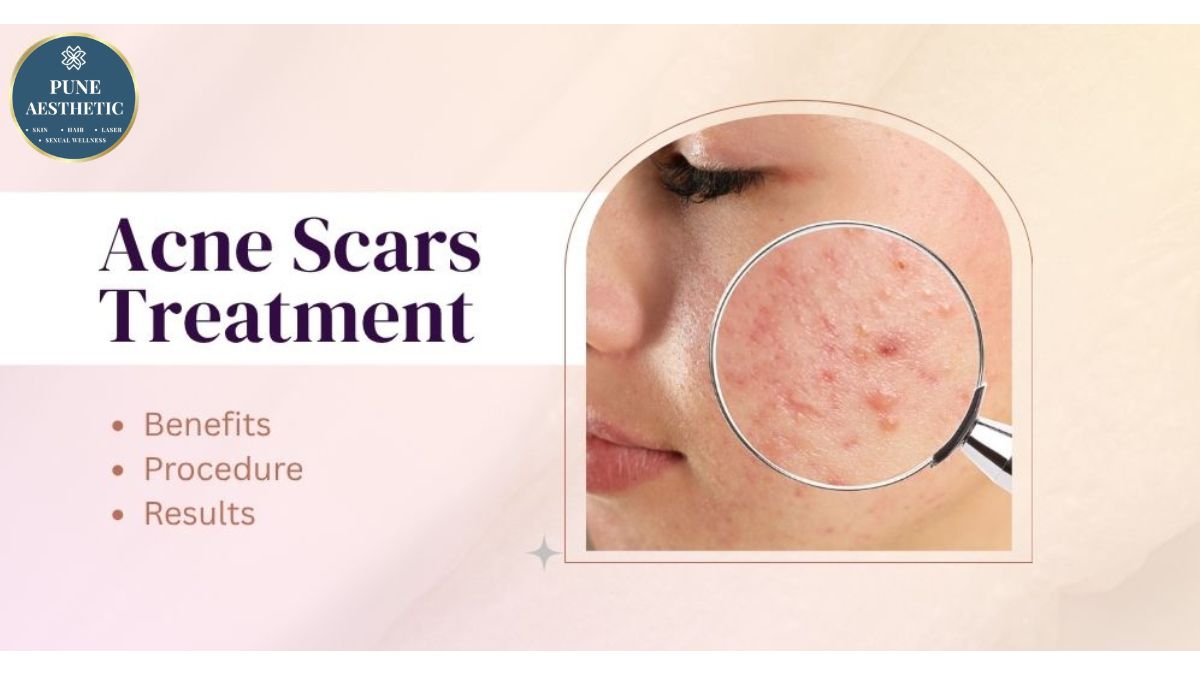 Acne Scars Treatment in Pune – Procedure, Benefits, Results & Recovery