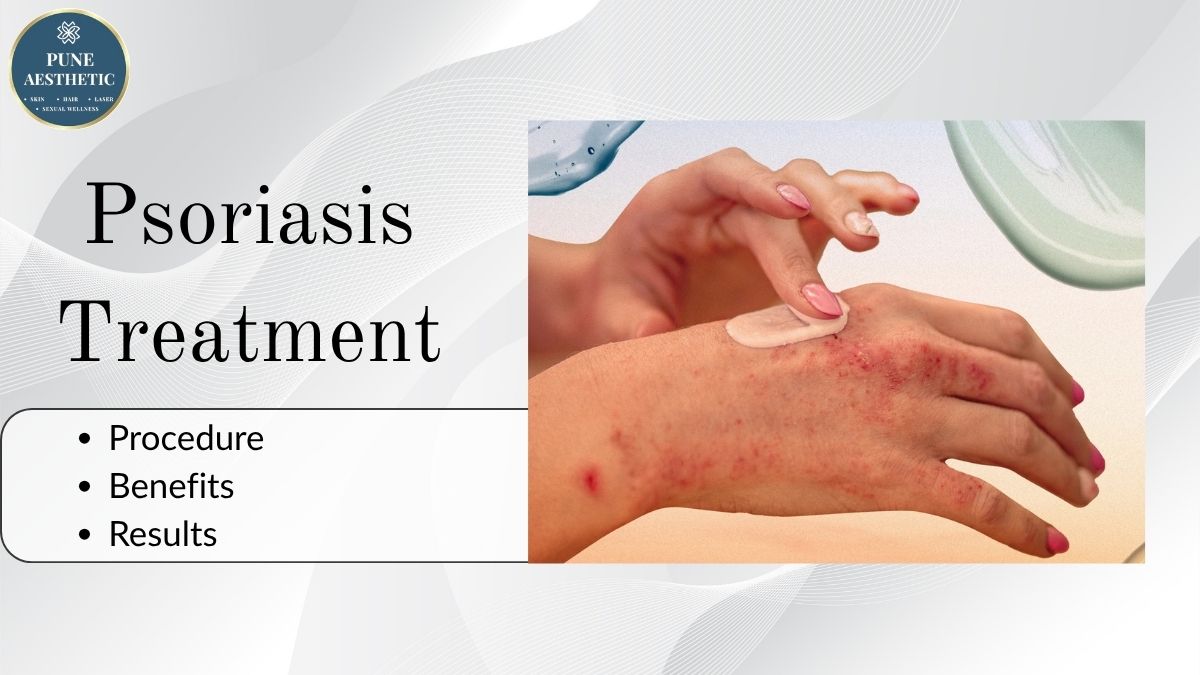 Psoriasis Treatment in Pune – Advanced Dermatology Care at Pune Aesthetic