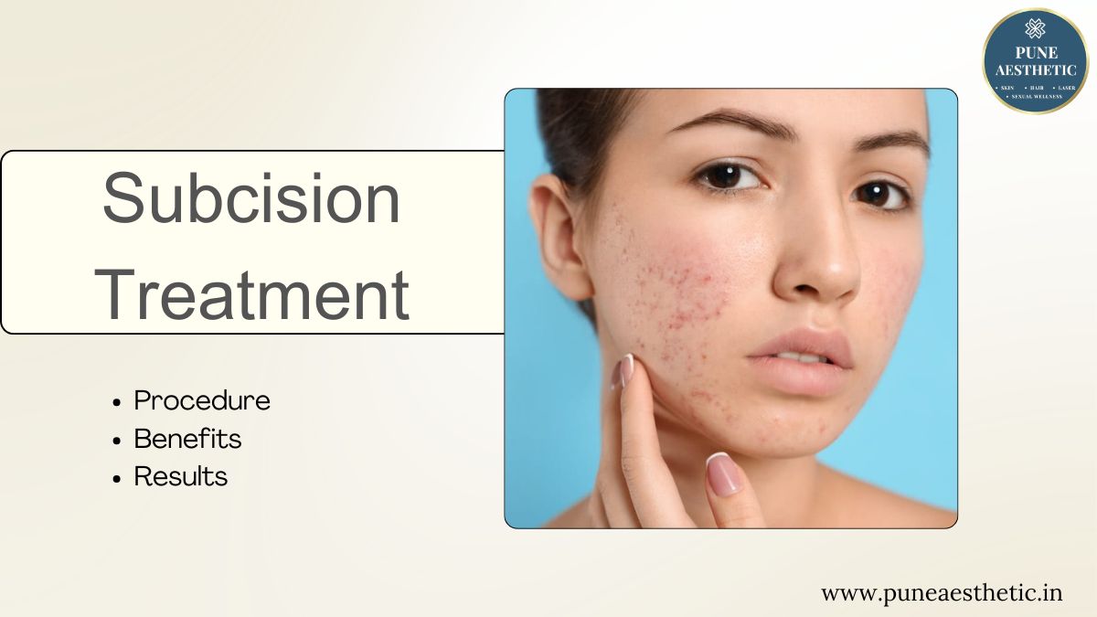 Subcision Treatment in Pune – An Effective Solution for Deep Acne Scars