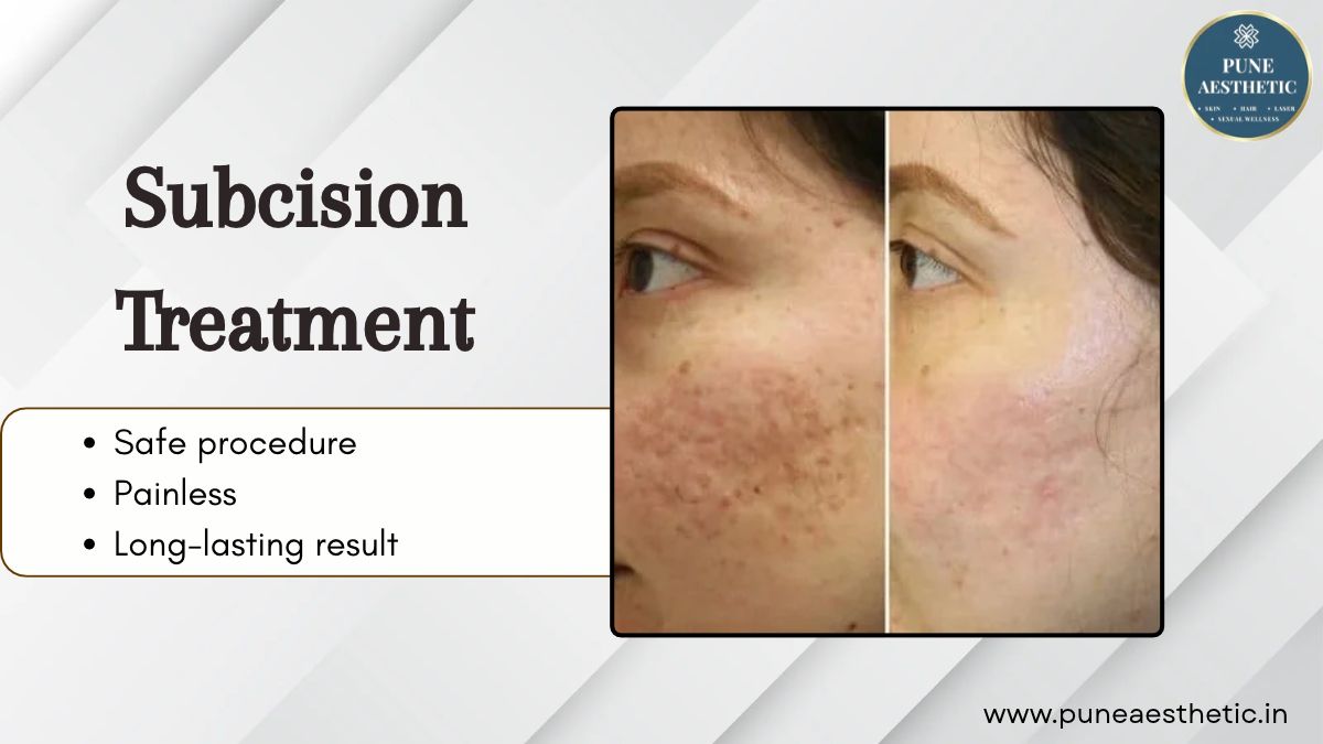 Subcision Treatment at Pune Aesthetic: Procedure, Benefits and Results