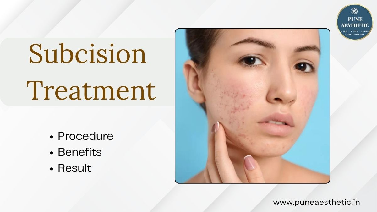 Subcision Treatment in Pune: Advanced Acne Scar Treatment for Smoother-Looking Skin