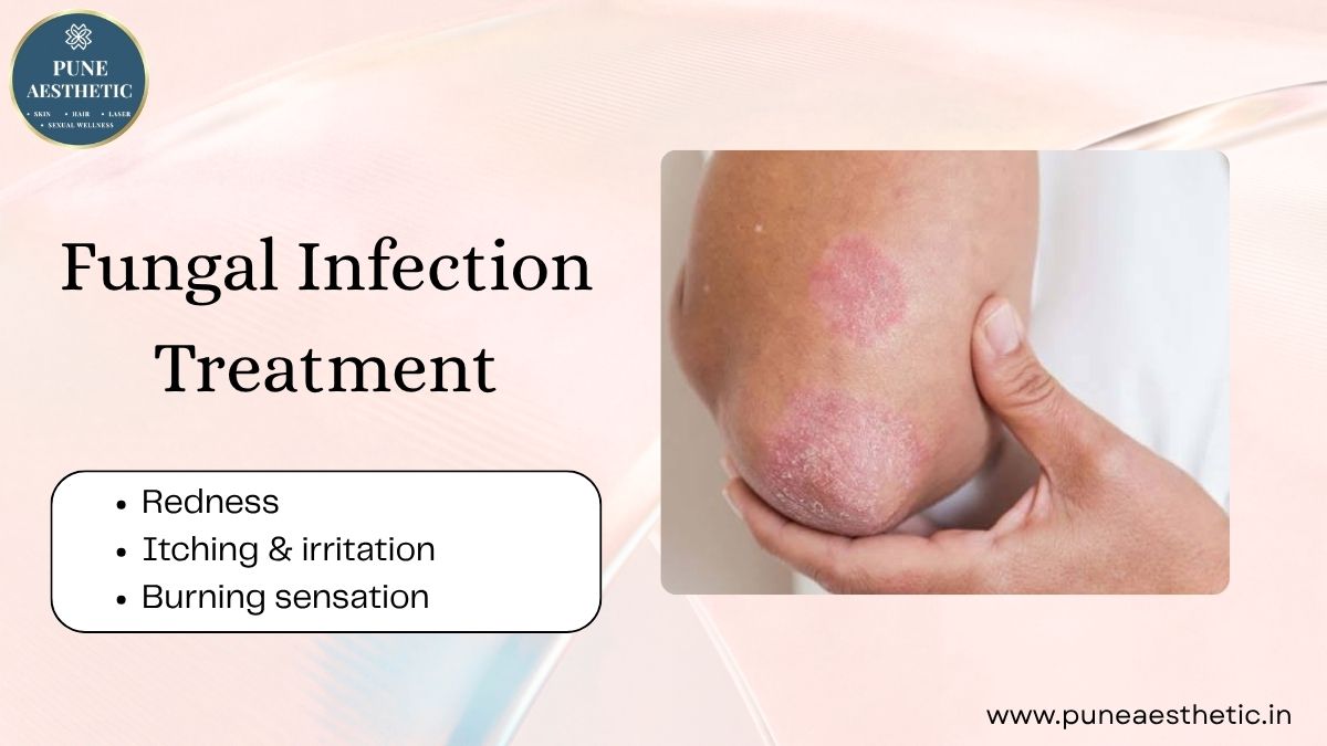 Fungal Infection Treatment in Pune – Effective Skin & Fungal Care at Pune Aesthetic