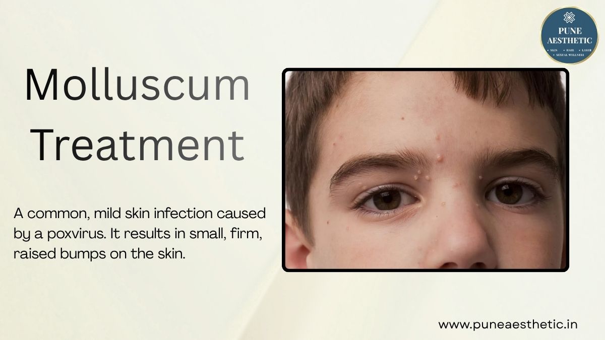 Molluscum Treatment in Pune: Effective Solutions for Clearer & Healthier-Looking Skin