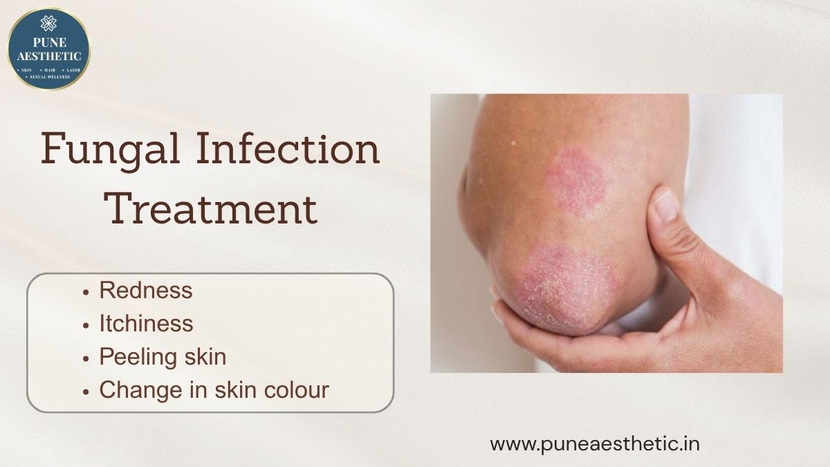 Fungal Infection Treatment in Pune: Causes, Symptoms, Procedure, Treatment & Prevention