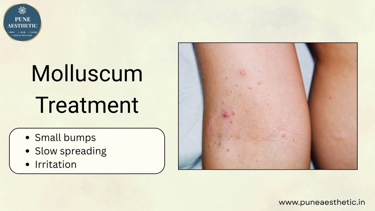 Molluscum Treatment in Pune – Effective Skin Care at Pune Aesthetic